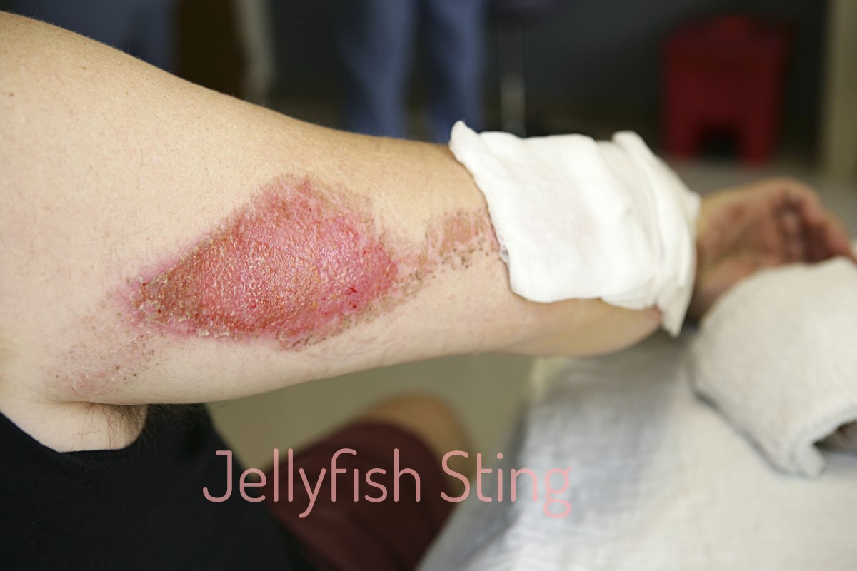 jellyfish-sting-what-to-do-to-relieve-it